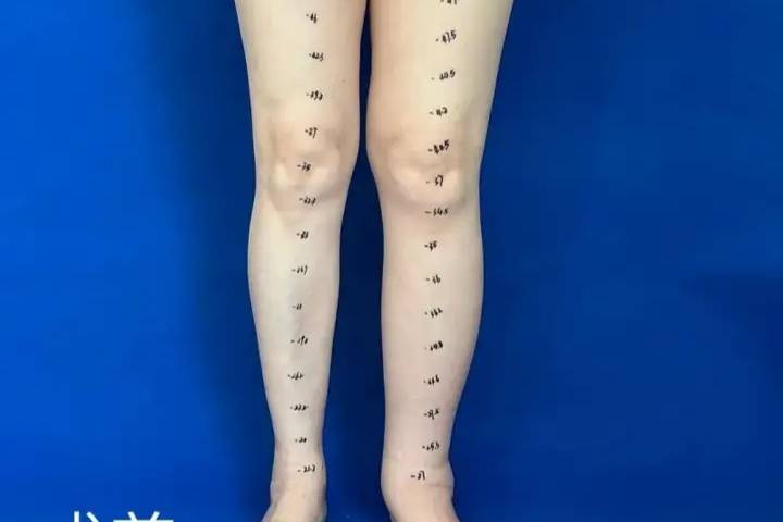 杭州邦爾骨科醫(yī)院為淋巴水腫患者鋪陳‘新生’之路